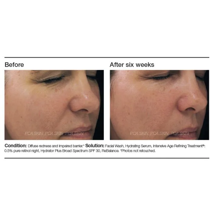 PCA Skin Intensive Age Refining Treatment®
