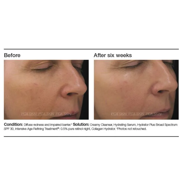 PCA Skin Intensive Age Refining Treatment®