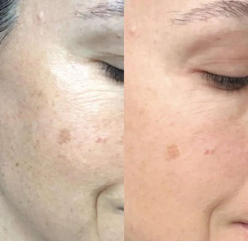 THE STRAIGHT A SERUM – Advanced Gentle Retinol Treatment